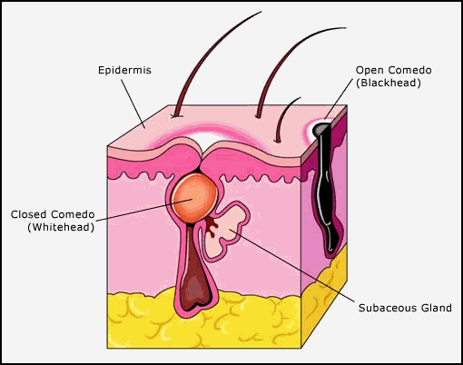 Model of skin acne