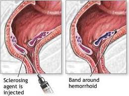 anus hemorrhoids anus hemorrhoids
