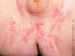 diaper rash-yeast infection