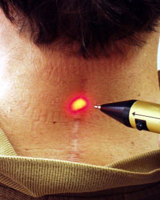 acne laser treatment