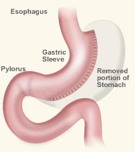 gastric sleeve operation