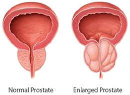 enlargedprostate